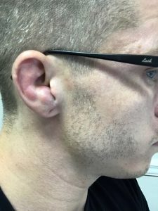 Clotted cauliflower ear