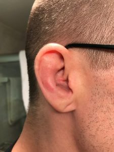 Drained cauliflower ear